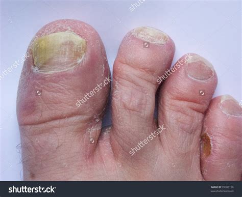 Athlete's Foot (Alipunga) .